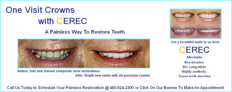 Dental Crowns in Mesa CEREC one hour crowns