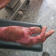 Post burn scarring and contracture hand