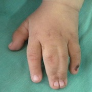 child with hand deformity, syndactyly