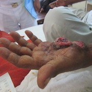 Cancer of hand
