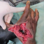 bullet injury to hand