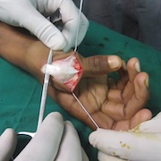 painful conditions of hand