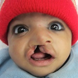 child with cleft lip