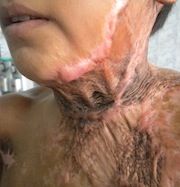 post burn scarring and contracture neck