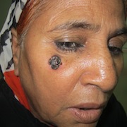 skin cancer, mole on face