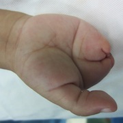 child with hand deformity, syndactyly