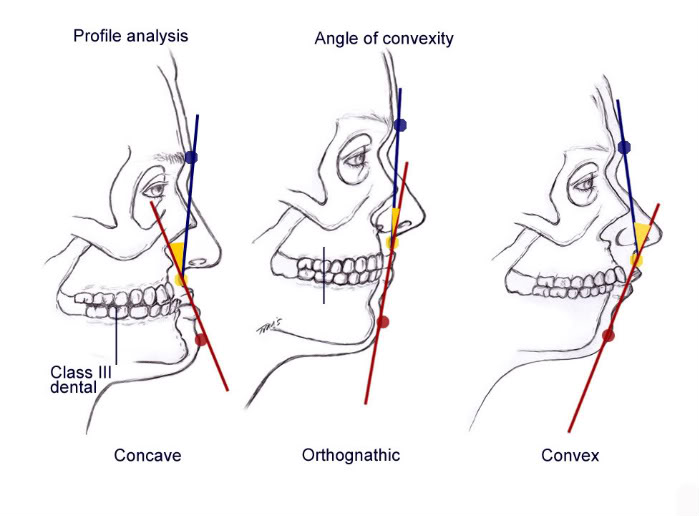 Cirurgia Ortognática